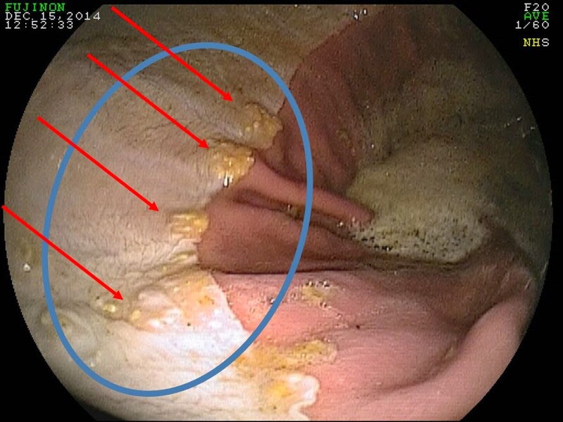 Natural Treatments For Ulcers In Horses Natural Treatments For Ulcers In Horses